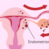 Endometriozis (Çikolata Kisti)