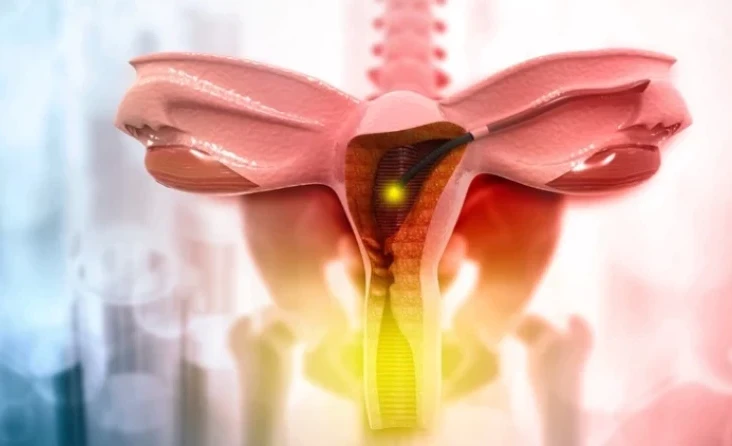 Polikistik Over Sendromu