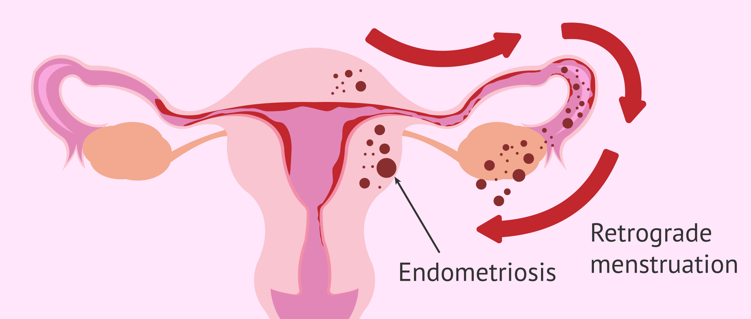Endometriozis (Çikolata Kisti)